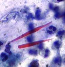 Imaging findings are highly suggestive of a fungal infection (e.g., nodular infiltrates with cavitation). Allergic Bronchopulmonary Aspergillosis Mimicking Lung Cancer A Case Report