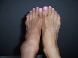 If you are suffering from a grade 1 sprain, you will feel only a little soreness. When Will I Feel Better Rose Physical Therapy Group