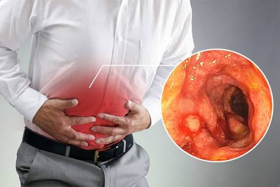 Viêm đại tràng mãn tính có chưa đươc không? | BvNTP