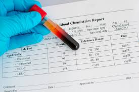 High Cholesterol Ups Risk Of Aggressive Prostate Cancer