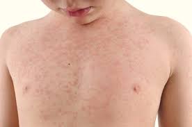 We did not find results for: Como Saber Si Es Urticaria O Alergia Criar Con Sentido Comun