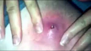 Be cautious with this essential oil as it is skin sensitive. Ingrown Hair Boil Removal Treatment Pictures Curehows