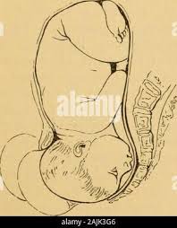 Image result for Manual Rotation in Occipitoposterior Presentation
