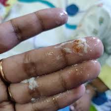 Hi Our Baby Is G6pd Deficient And Pediatrician Has Prescribed Tonoferon Drops Multivitamin Iron Drops Since Yesterday We Have Started It Today Evening He Has Spitted Milk And We Saw Traces Of