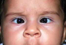 Read about eye cancer, including the symptoms, causes, treatments, and outlook. Squint Causes Symptoms And Treatment