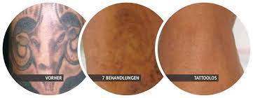 After all, for tattoo removal laser treatment is the best tattoo removal methods. Before And After Pictures Tattoolos