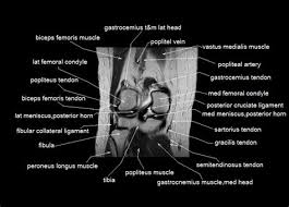 Main supply are the genicular branches of the popliteal artery; Normal Male Pelvis Mri Shefalitayal
