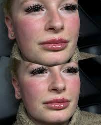 Lip augmentation built for 𝙔𝙊𝙐 👄 Are you looking to perfect your lips?  Look no further I tailor all of my treatments to suit your desired results…  If you are looking for