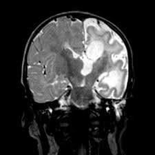 Multilocularis, and describes a spectrum of disease involving the spinal cord, the spine, or both. Encephalitis Ct Scan Radiopaedia Ct Scan Machine