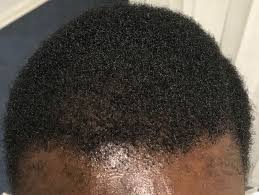 But most people have nonscarring hair loss, dr. Afro Hair Transplant Holborn Hair Scalp Clinic London