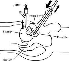 Image result for Bladder Irrigation
