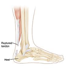 Treatment is usually surgery to reattach the torn edges of the ruptured tendon. Achilles Tendon Rupture Saint Luke S Health System