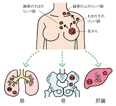 乳がん 肝臓 転移 治療