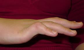 Many people only notice their pinky fingers are bent, or slightly crooked, when they hold their fingers side by side and survey them. Finger Outlander Anatomy