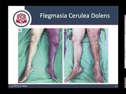 Cómo detectar y prevenir la trombosis venosa profunda cuando el coágulo crece. Trombosis Venosa Profunda Youtube