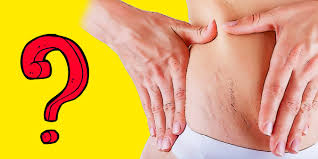 Vucut Gelistirmede Ortaya Cikan Deri Catlaklari