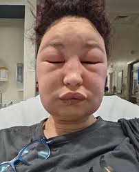 Picada por una abeja 🐝 Una mujer de unos 30 años fue picada una vez en el  puente de su nariz por una abeja. Durante las próximas 24 horas, su  reacción se