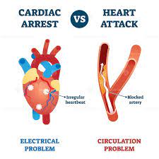 Cardiac Arrest Vs Heart Attack Vector Illustration Cardiac Arrest Cardiac Cardiac Anatomy