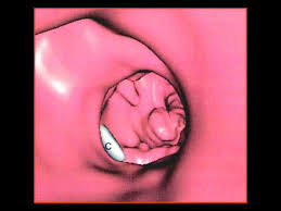 Epos Trade Aaas are classified by location as either suprarenal or infrarenal aneurysms.