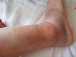 Kingbrand.com has been visited by 10k+ users in the past month Ankle Sprains Healing Times Why Rest Is Not The Answer