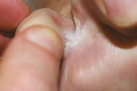 Les raisons (f) pour lesquelles nous sommes parties sont confidentielles. La Dermatophytose Des Pieds Une Pathologie Frequente Chez Le Sportif La Medecine Du Sport