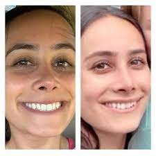 Botox Lip Flip