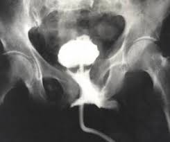 Image result for Retrograde Urethrogram