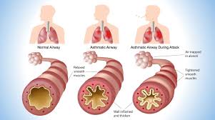 Pediatric Lung Diseases Disorders Pediatric Pulmonologists