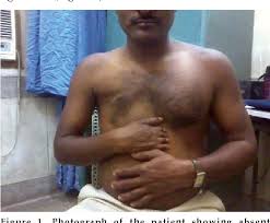 Poland's syndrome is a rare congenital anomaly that may include mammary hypoplasia and has been described in association with various malignancies. Figure 1 From Poland S Syndrome With Unusual Hand And Chest Anomalies A Rare Case Report Semantic Scholar