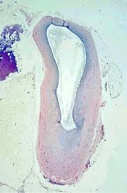 Pathology Outlines - Ganglion