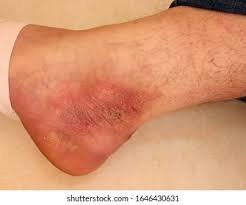 Image result for Lichen Simplex Chronicus