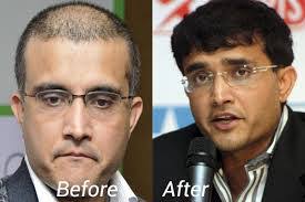 The career of the celebrity could have ended due to this. Famous Celebrity Hair Transplants Ak Clinics