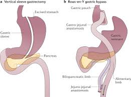 A bariatric surgeon specializes in treating obesity in people who have not had success with medical weight loss programs. Bariatric Surgery For The Treatment Of Chronic Kidney Disease In Obesity And Type 2 Diabetes Mellitus Nature Reviews Nephrology