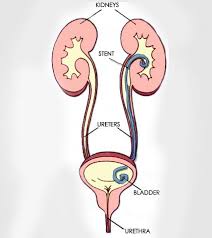 Ureteral Stents What You Need To Know
