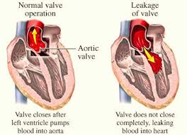 Pin On Heart Valve Replacement