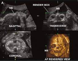 Genetic Sonography 3d Us