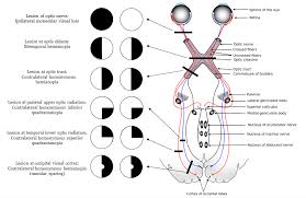 Visual Field Defects Optic Nerve Occipital Lobe Visual