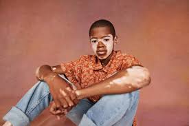 Image result for Vitiligo