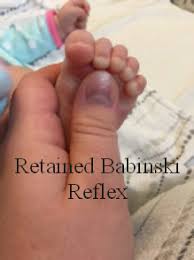 Image result for Babinski Reflex