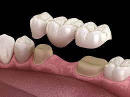 How long does it take for dental bridge to settle. Aesthetic Dentistry Of Wickford Blog
