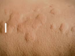 Worst Pregnancy Side Effect Ever For Me It S Hives Babycenter