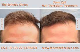 Hair loss and thinning hair have been a problem for men and women since the conception of time. Stem Cells Treatment Mumbai Stem Cells Therapy Cost India The Esthetic Clinics