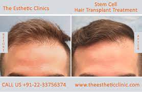 Stem cell therapy is the use of stem cells to treat or prevent a disease or condition. Stem Cells Treatment Mumbai Stem Cells Therapy Cost India The Esthetic Clinics