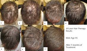 The irestore is fda certified and dim fit for hair loss recovery. Laser Hair Therapy For Hair Regrowth For Thinning Hair Jk Hair