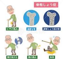 骨密度のイラスト素材 - PIXTA
