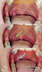 Image result for papillomavirus tongue)
