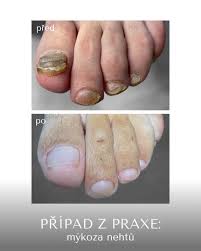 Image result for mykoza nehtů