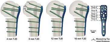 The data is only saved locally (on your computer) and never transferred to us. Screw Hole Configuration Utilised And Method For Measuring Download Scientific Diagram