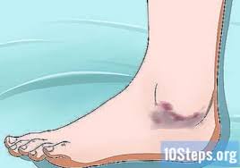Nyeri sakit gigi tidak hanya bikin ngilu saat mengunyah makanan, tapi bisa membuat sakit kepala dan demam. Cara Menenangkan Pergelangan Kaki Sakit 13 Langkah Dengan Gambar Ilmu 2021