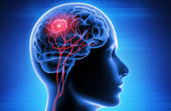 Image result for how long should therapy treatment for brain injury be
